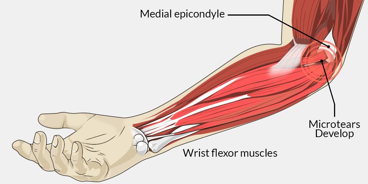 Epicondylitis medial Medial Epicondylitis: